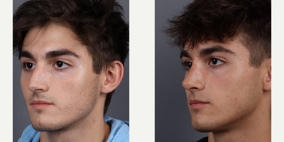 Case 3783 - Woman treated with Rhinoplasty