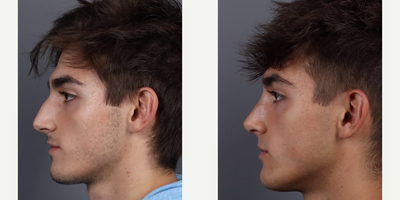 Case 3784 - Woman treated with Rhinoplasty