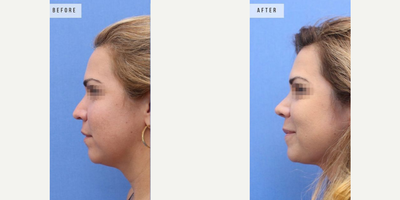 Case 3785 - Woman treated with Rhinoplasty