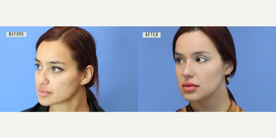 Case 3786 - Woman treated with Rhinoplasty