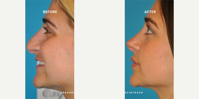Case 3787 - Woman treated with Rhinoplasty