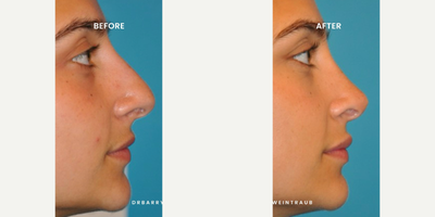 Case 3788 - Woman treated with Rhinoplasty