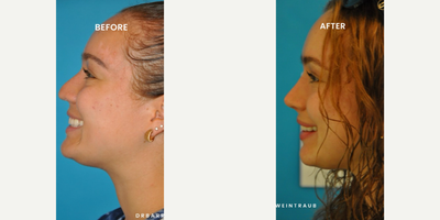 Case 3789 - Woman treated with Rhinoplasty