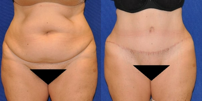 Case 379 - Tummy Tuck
