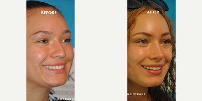 Case 3790 - Woman treated with Rhinoplasty