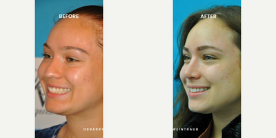 Case 3791 - Woman treated with Rhinoplasty