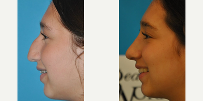 Case 3792 - Woman treated with Rhinoplasty