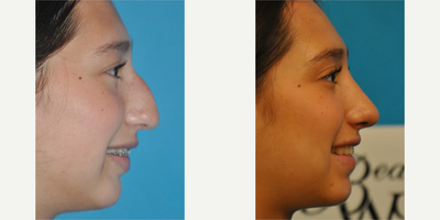 Case 3793 - Woman treated with Rhinoplasty