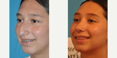 Case 3794 - Woman treated with Rhinoplasty