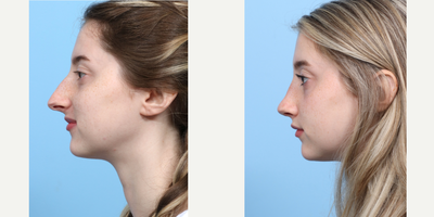 Case 3795 - 18-24 year old woman treated with Rhinoplasty