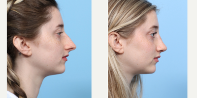 Case 3796 - 18-24 year old woman treated with Rhinoplasty