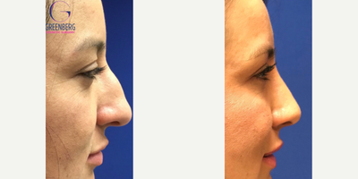 Case 3797 - Woman treated with Rhinoplasty