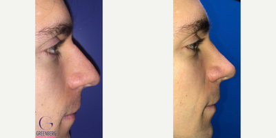 Case 3798 - Woman treated with Rhinoplasty