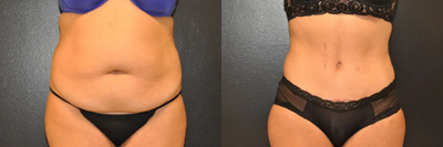 Case 38 - Woman treated with Tummy Tuck