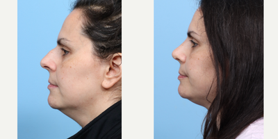 Case 3800 - 35-44 year old woman treated with Rhinoplasty