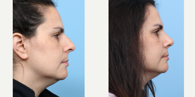 Case 3801 - 35-44 year old woman treated with Rhinoplasty