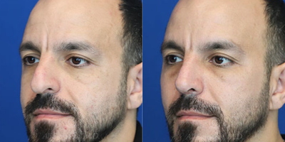 Case 3802 - Man treated with Rhinoplasty