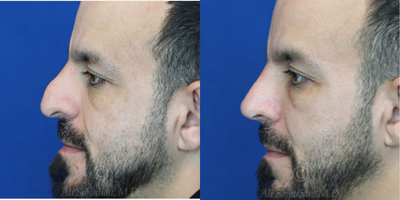 Case 3803 - Man treated with Rhinoplasty