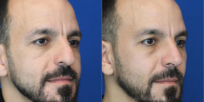 Case 3804 - Man treated with Rhinoplasty
