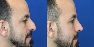 Case 3805 - Man treated with Rhinoplasty