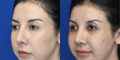 Case 3806 - Woman treated with Rhinoplasty