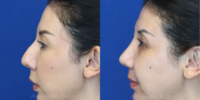 Case 3807 - Woman treated with Rhinoplasty