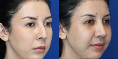 Case 3808 - Woman treated with Rhinoplasty