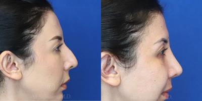 Case 3809 - Woman treated with Rhinoplasty