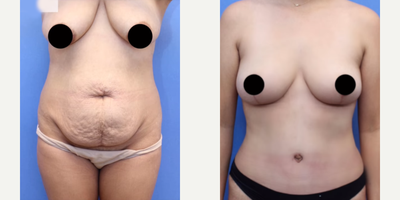 Case 381 - Mommy Makeover, Breast Lift, Tummy Tuck