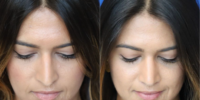 Case 3810 - Woman treated with Rhinoplasty