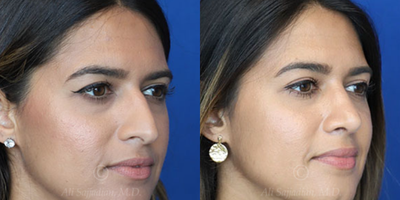 Case 3811 - Woman treated with Rhinoplasty