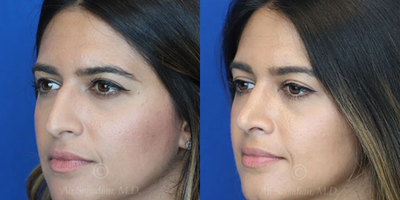 Case 3812 - Woman treated with Rhinoplasty