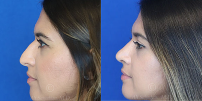 Case 3813 - Woman treated with Rhinoplasty