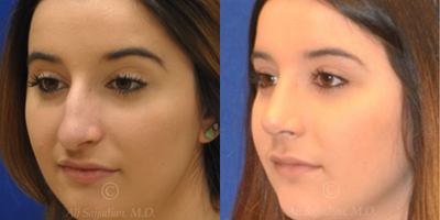 Case 3814 - Woman treated with Rhinoplasty