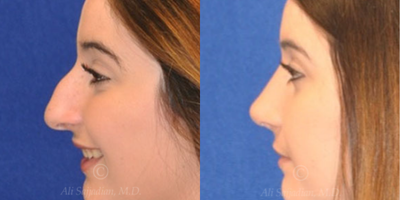 Case 3815 - Woman treated with Rhinoplasty