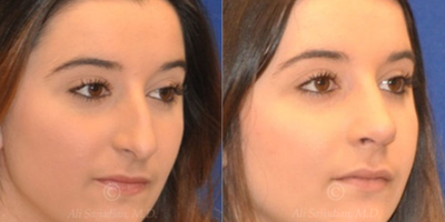 Case 3816 - Woman treated with Rhinoplasty