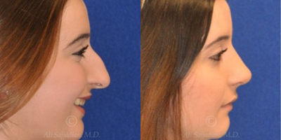 Case 3817 - Woman treated with Rhinoplasty