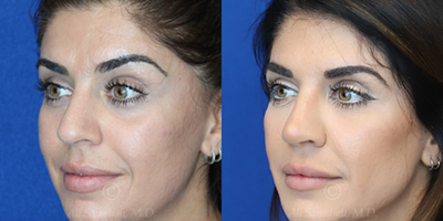 Case 3818 - Woman treated with Rhinoplasty