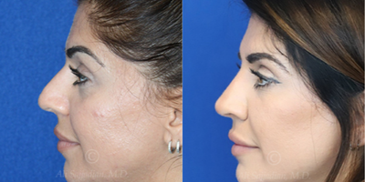 Case 3819 - Woman treated with Rhinoplasty
