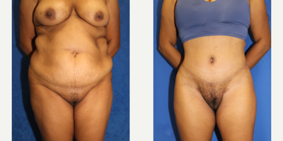 Case 382 - 35-44 year old woman treated with Tummy Tuck