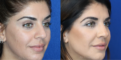 Case 3820 - Woman treated with Rhinoplasty