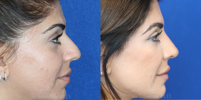 Case 3821 - Woman treated with Rhinoplasty
