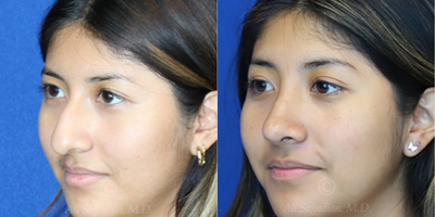 Case 3822 - Woman treated with Rhinoplasty