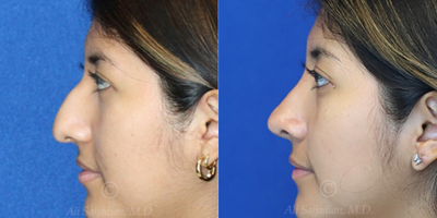 Case 3823 - Woman treated with Rhinoplasty