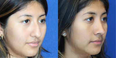Case 3824 - Woman treated with Rhinoplasty