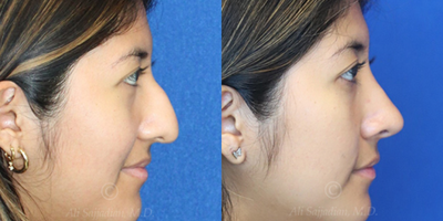 Case 3825 - Woman treated with Rhinoplasty