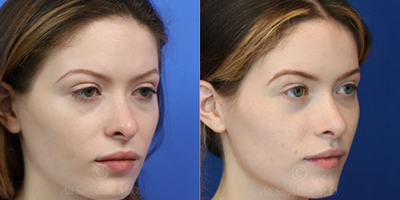 Case 3827 - Woman treated with Rhinoplasty