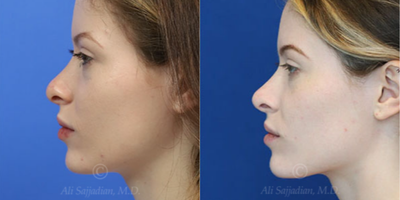 Case 3828 - Woman treated with Rhinoplasty