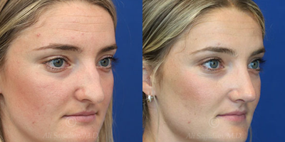 Case 3829 - Woman treated with Rhinoplasty