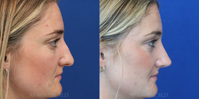Case 3830 - Woman treated with Rhinoplasty